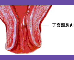 宫颈息肉的预防方法都有哪些